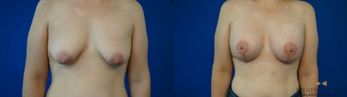 Before & After Breast Lift (Breast Mastopexy with Implants) Case 353 Front View in Fort Worth & Arlington, Texas