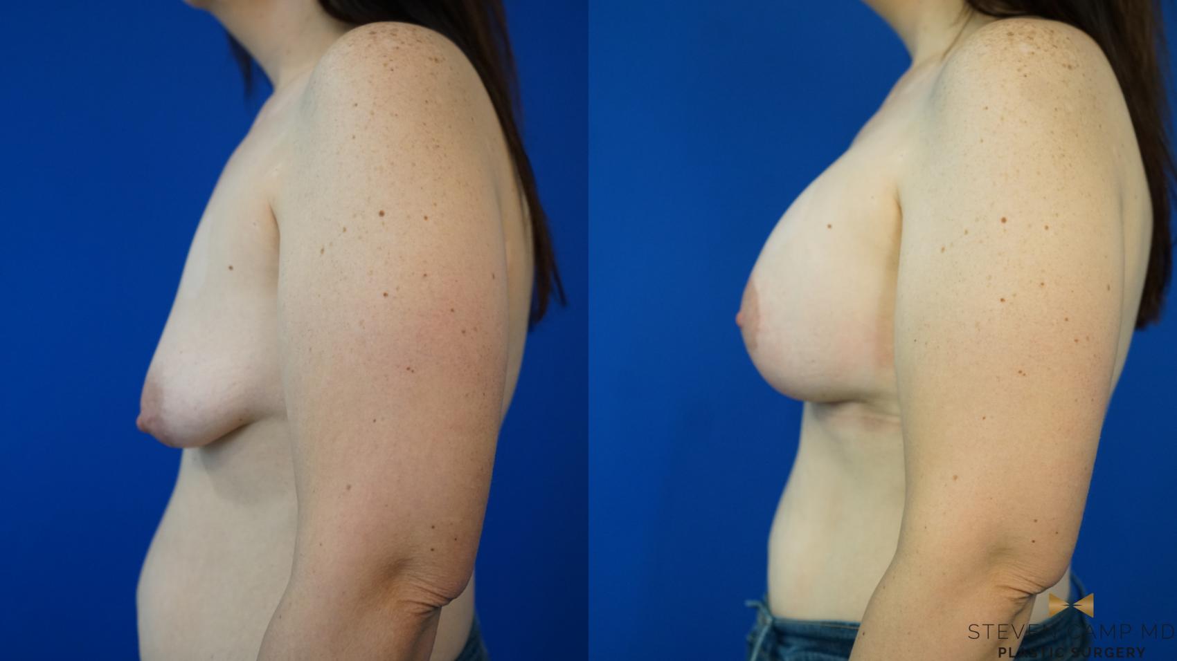 Before & After Breast Lift (Breast Mastopexy with Implants) Case 353 Left Side View in Fort Worth & Arlington, Texas