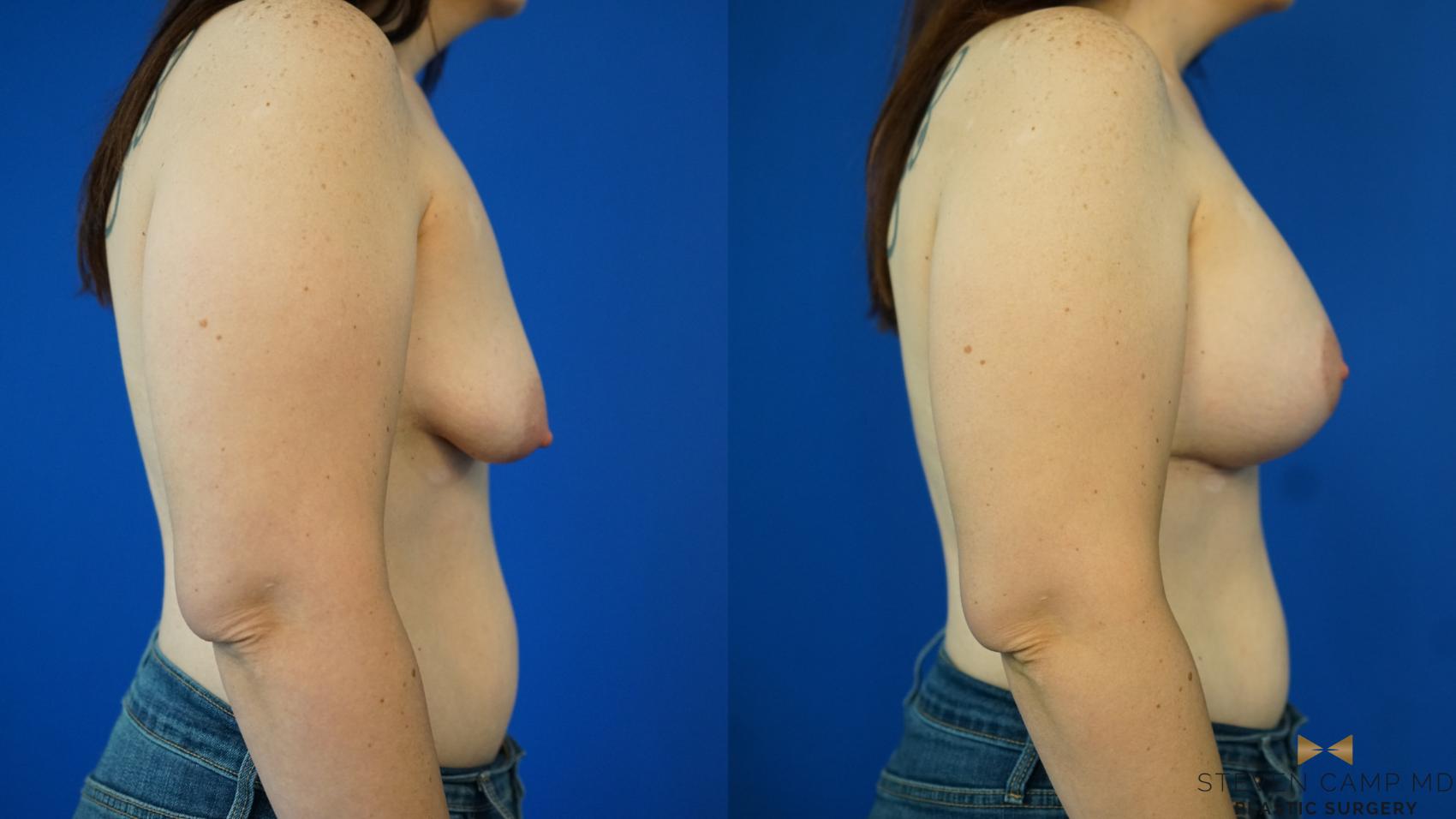 Before & After Breast Lift (Breast Mastopexy with Implants) Case 353 Right Side View in Fort Worth & Arlington, Texas