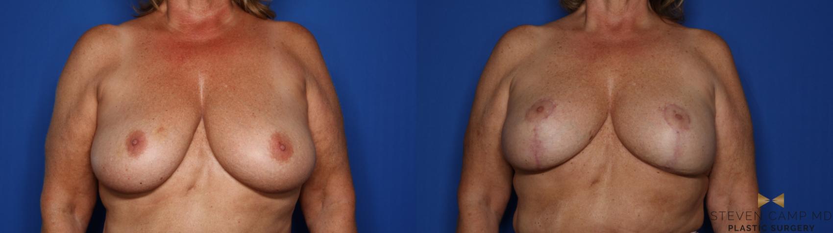 Before & After Breast Lift (Breast Mastopexy with Implants) Case 411 Front View in Fort Worth & Arlington, Texas