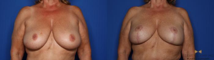 Before & After Breast Lift (Breast Mastopexy with Implants) Case 411 Front View in Fort Worth & Arlington, Texas