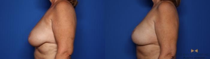 Before & After Breast Lift (Breast Mastopexy with Implants) Case 411 Left Side View in Fort Worth & Arlington, Texas