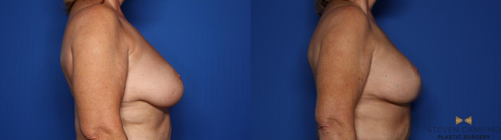 Before & After Breast Lift (Breast Mastopexy with Implants) Case 411 Right Side View in Fort Worth & Arlington, Texas