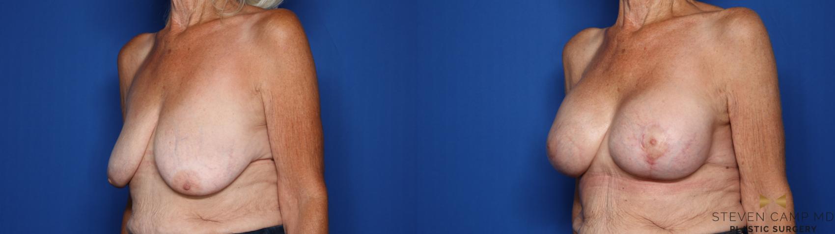 Before & After Breast Lift (Breast Mastopexy with Implants) Case 430 Left Oblique View in Fort Worth & Arlington, Texas