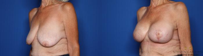 Before & After Breast Lift (Breast Mastopexy with Implants) Case 430 Left Oblique View in Fort Worth & Arlington, Texas