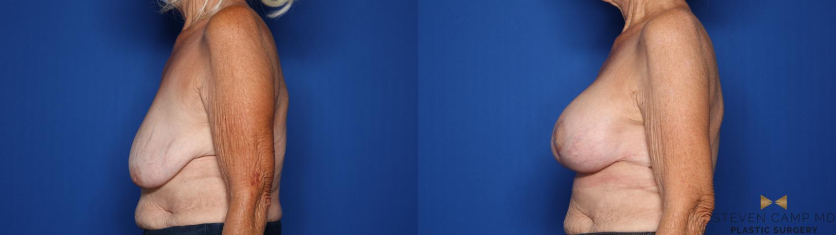 Before & After Breast Lift (Breast Mastopexy with Implants) Case 430 Left Side View in Fort Worth & Arlington, Texas