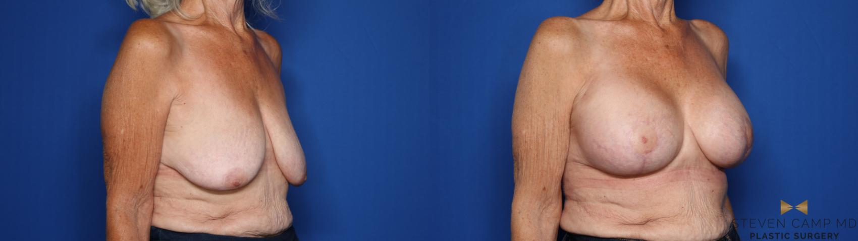 Before & After Breast Lift (Breast Mastopexy with Implants) Case 430 Right Oblique View in Fort Worth & Arlington, Texas