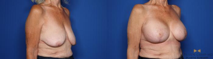 Before & After Breast Lift (Breast Mastopexy with Implants) Case 430 Right Oblique View in Fort Worth & Arlington, Texas