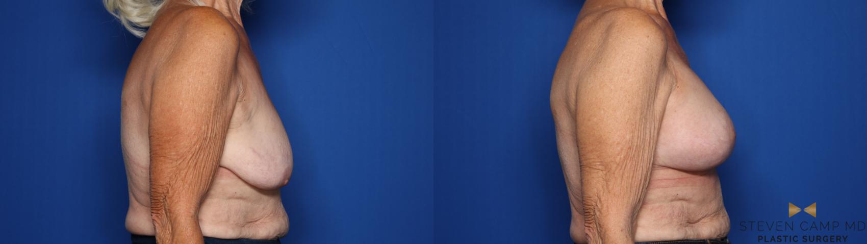Before & After Breast Lift (Breast Mastopexy with Implants) Case 430 Right Side View in Fort Worth & Arlington, Texas