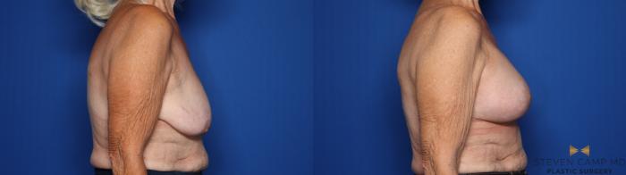 Before & After Breast Lift (Breast Mastopexy with Implants) Case 430 Right Side View in Fort Worth & Arlington, Texas