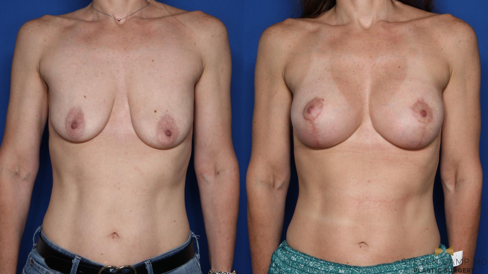 Before & After Breast Lift (Breast Mastopexy with Implants) Case 457 Front View in Fort Worth & Arlington, Texas