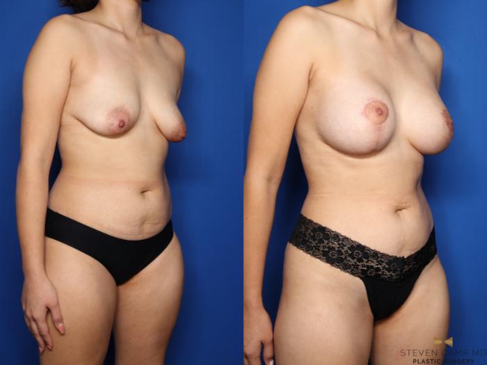 Before & After Breast Lift (Breast Mastopexy with Implants) Case 481 Right Oblique View in Fort Worth & Arlington, Texas