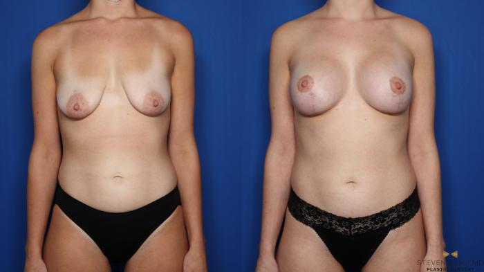 Before & After Breast Lift (Breast Mastopexy with Implants) Case 508 Front View in Fort Worth & Arlington, Texas