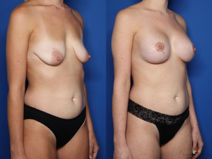 Before & After Breast Lift (Breast Mastopexy with Implants) Case 508 Right Oblique View in Fort Worth & Arlington, Texas