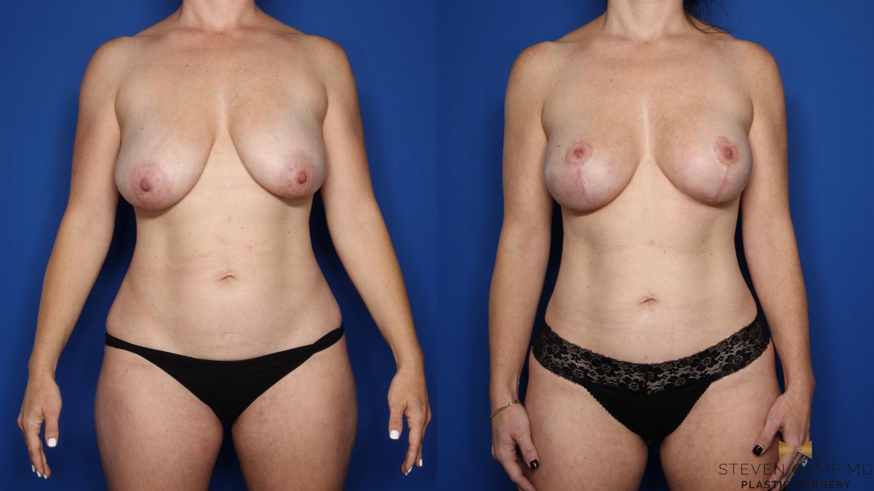 Before & After Breast Lift (Breast Mastopexy with Implants) Case 551 Front View in Fort Worth & Arlington, Texas