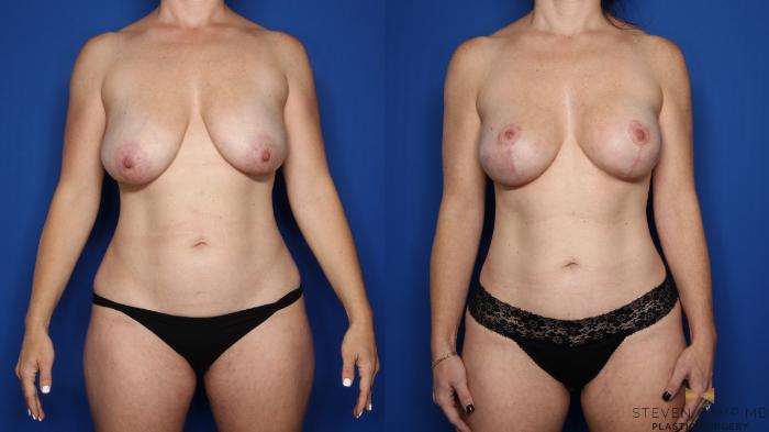Before & After Breast Lift (Breast Mastopexy with Implants) Case 551 Front View in Fort Worth & Arlington, Texas