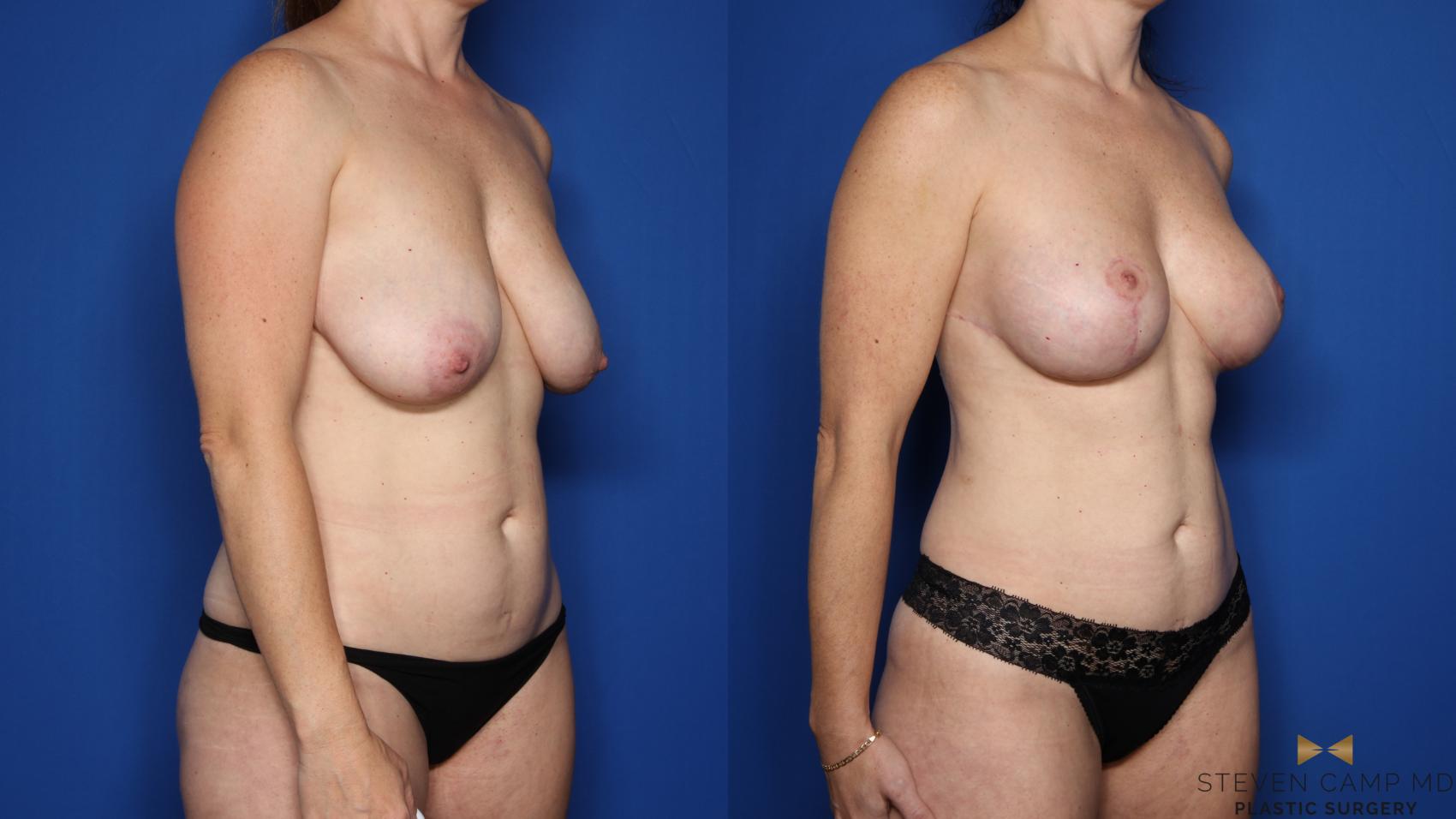 Before & After Breast Lift (Breast Mastopexy with Implants) Case 551 Right Oblique View in Fort Worth & Arlington, Texas