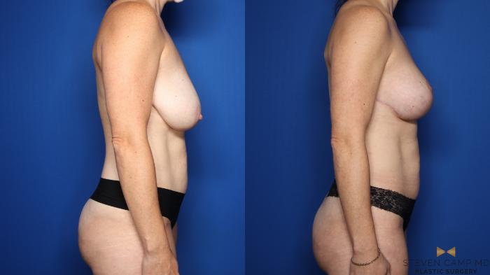 Before & After Breast Lift (Breast Mastopexy with Implants) Case 551 Right Side View in Fort Worth & Arlington, Texas