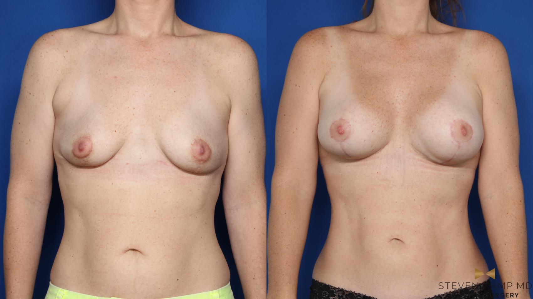 Before & After Breast Lift (Breast Mastopexy with Implants) Case 587 Front View in Fort Worth & Arlington, Texas
