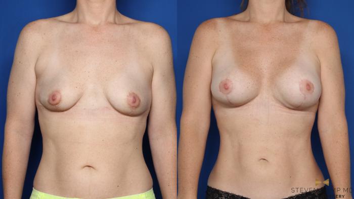 Before & After Breast Lift (Breast Mastopexy with Implants) Case 587 Front View in Fort Worth & Arlington, Texas