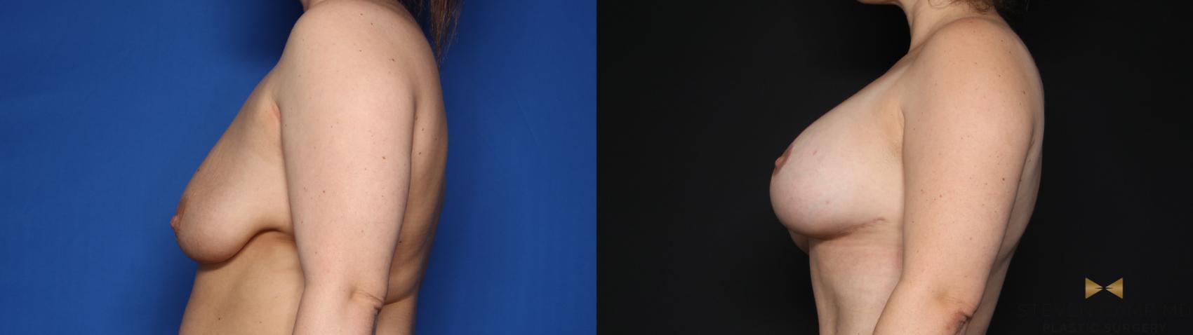 Before & After Breast Lift (Breast Mastopexy with Implants) Case 632 Left Side View in Fort Worth & Arlington, Texas