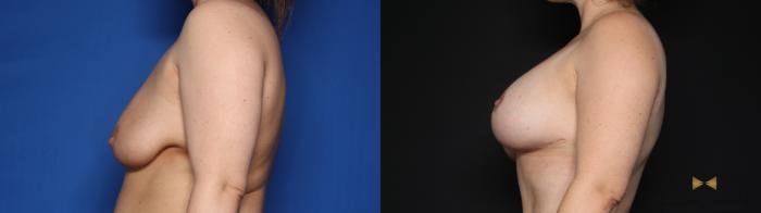 Before & After Breast Lift (Breast Mastopexy with Implants) Case 632 Left Side View in Fort Worth & Arlington, Texas