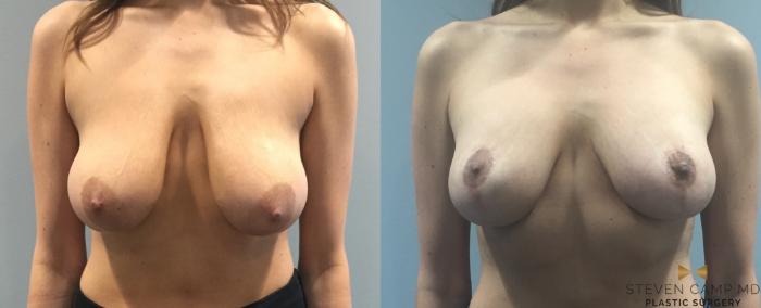 Before & After Breast Lift (Breast Mastopexy with Implants) Case 93 View #2 View in Fort Worth & Arlington, Texas