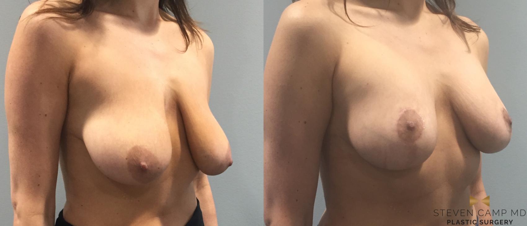 Before & After Breast Lift (Breast Mastopexy with Implants) Case 93 View #4 View in Fort Worth & Arlington, Texas