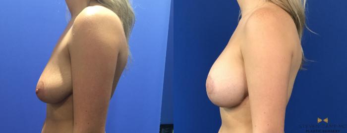 Before & After Breast Lift with or without Implants Case 120 View #2 View in Fort Worth, Texas