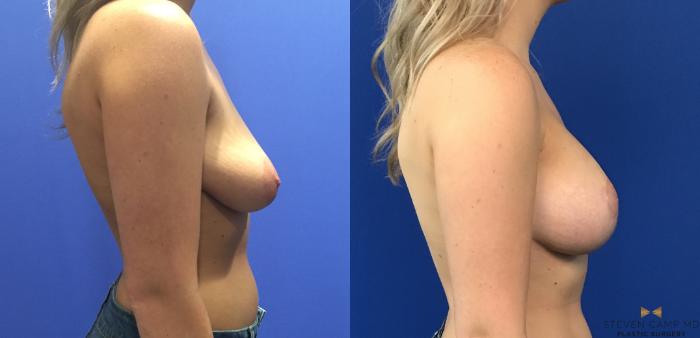 Before & After Breast Lift with or without Implants Case 120 View #4 View in Fort Worth, Texas