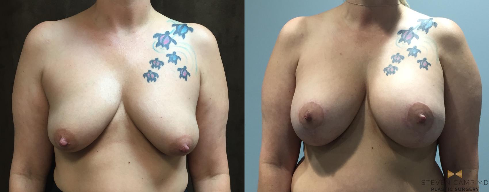 Before & After Breast Lift (Breast Mastopexy with Implants) Case 121 View #1 View in Fort Worth & Arlington, Texas