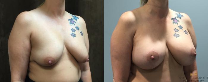 Before & After Breast Lift with or without Implants Case 121 View #4 View in Fort Worth, Texas