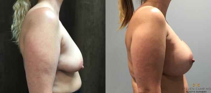 Before & After Breast Lift with or without Implants Case 121 View #5 View in Fort Worth, Texas