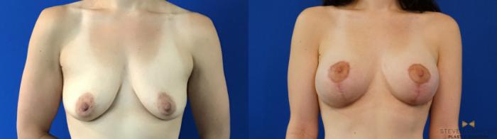 Before & After Breast Lift (Breast Mastopexy with Implants) Case 132 View #1 View in Fort Worth & Arlington, Texas