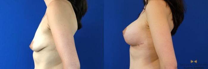 Before & After Breast Lift (Breast Mastopexy with Implants) Case 132 View #3 View in Fort Worth & Arlington, Texas
