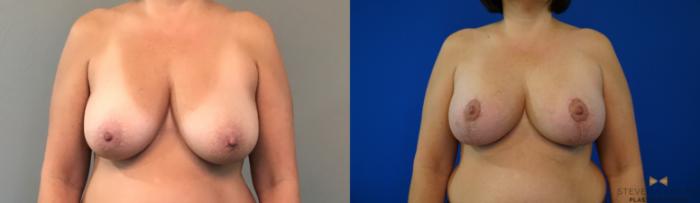 Before & After Breast Lift with or without Implants Case 134 View #2 View in Fort Worth, Texas