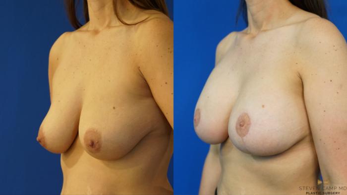 Before & After Breast Lift with or without Implants Case 165 View #2 View in Fort Worth, Texas