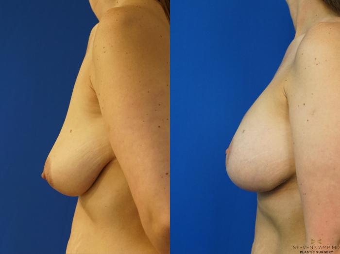 Before & After Breast Lift with or without Implants Case 165 View #3 View in Fort Worth, Texas