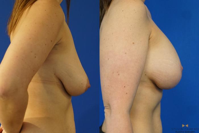 Before & After Breast Lift with or without Implants Case 165 View #5 View in Fort Worth, Texas