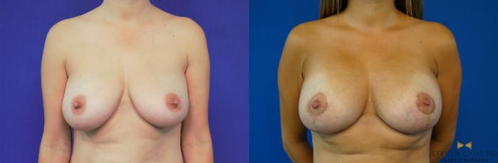 Before & After Breast Lift with or without Implants Case 169 View #2 View in Fort Worth, Texas