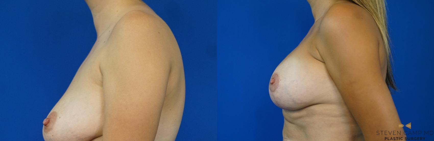 Before & After Breast Lift (Breast Mastopexy with Implants) Case 169 View #3 View in Fort Worth & Arlington, Texas