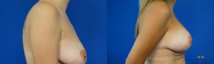 Before & After Breast Lift with or without Implants Case 169 View #5 View in Fort Worth, Texas