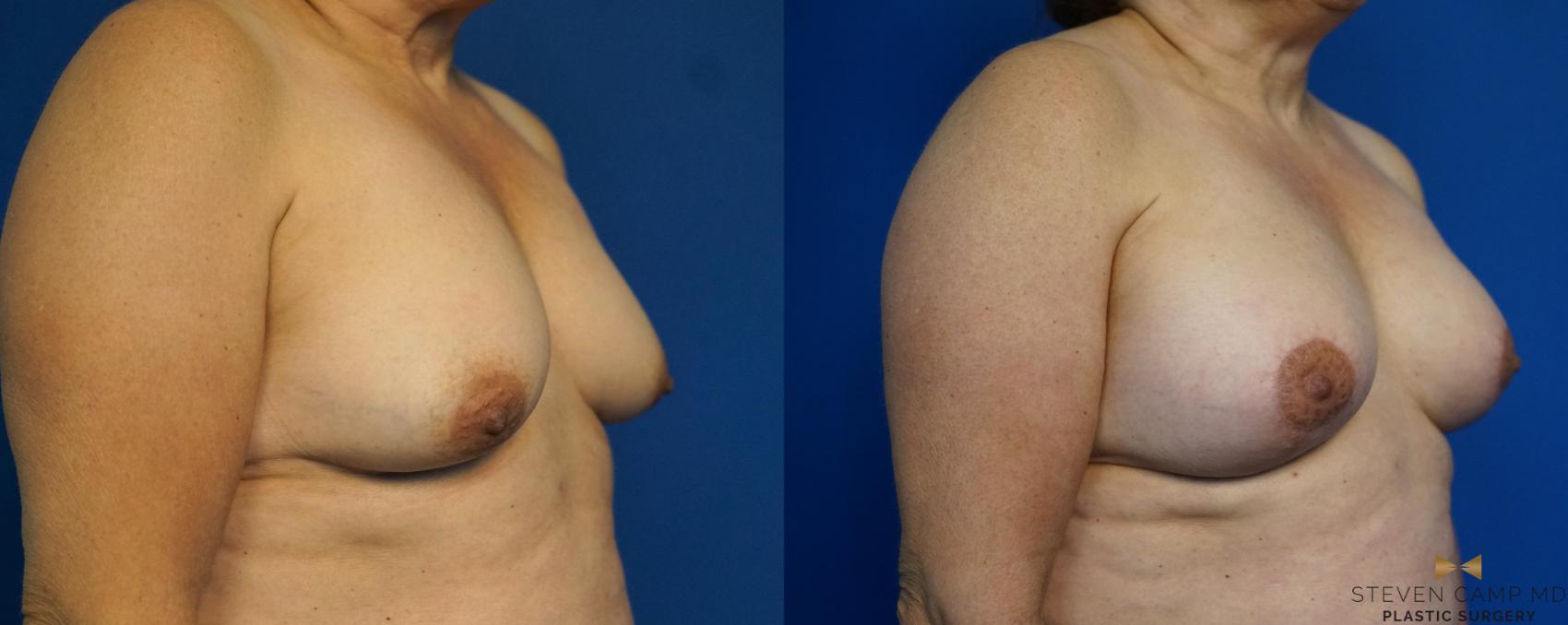 Before & After Breast Lift (Breast Mastopexy with Implants) Case 212 View #2 View in Fort Worth & Arlington, Texas