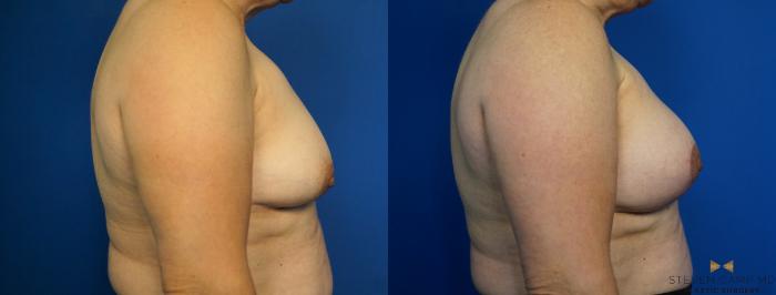 Before & After Breast Lift with or without Implants Case 212 View #3 View in Fort Worth, Texas