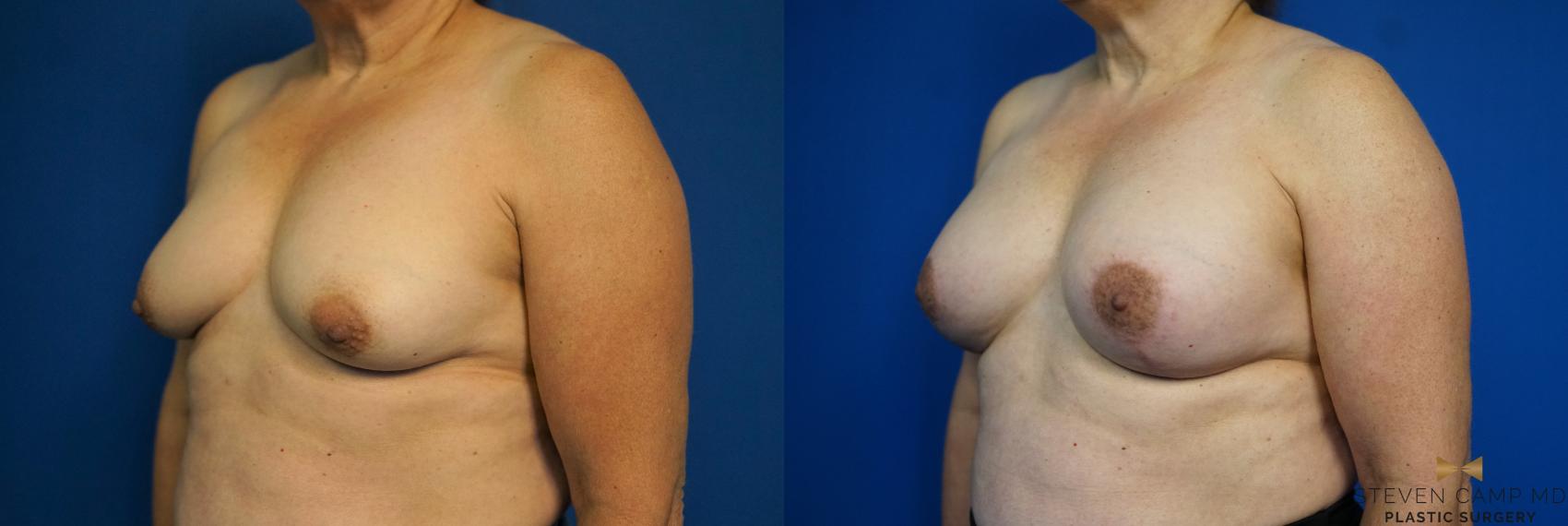 Before & After Breast Lift (Breast Mastopexy with Implants) Case 212 View #4 View in Fort Worth & Arlington, Texas