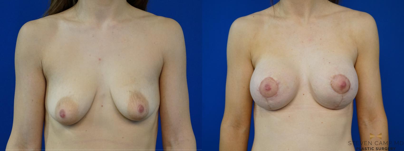 Before & After Breast Lift with or without Implants Case 213 View #1 View in Fort Worth, Texas