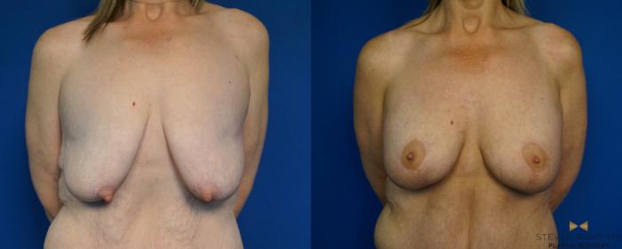 Before & After Breast Lift (Breast Mastopexy with Implants) Case 214 View #1 View in Fort Worth & Arlington, Texas