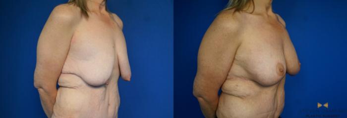 Before & After Breast Lift with or without Implants Case 214 View #2 View in Fort Worth, Texas