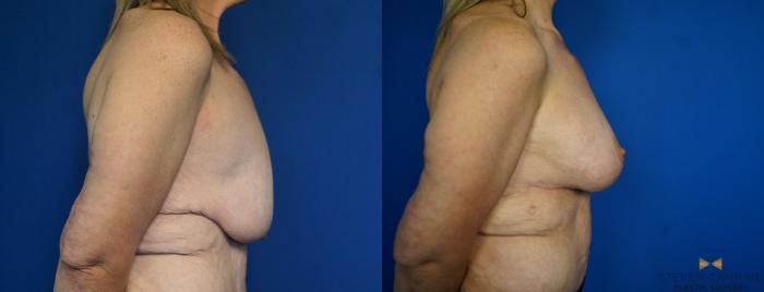 Before & After Breast Lift (Breast Mastopexy with Implants) Case 214 View #3 View in Fort Worth & Arlington, Texas