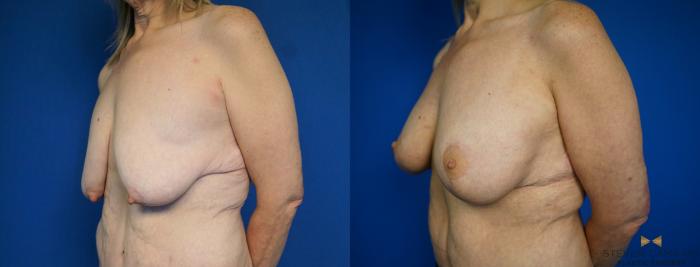 Before & After Breast Lift with or without Implants Case 214 View #4 View in Fort Worth, Texas